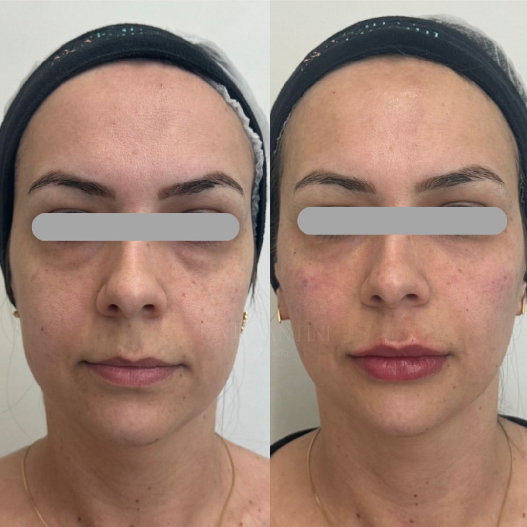 Harmonização Facial