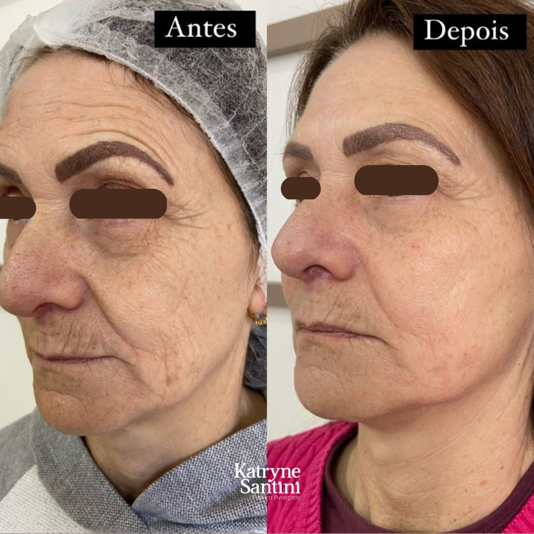 Rejuvenescimento Facial (2)