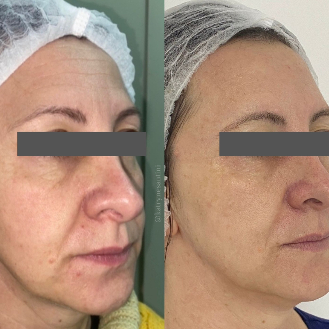 Rejuvenescimento Facial