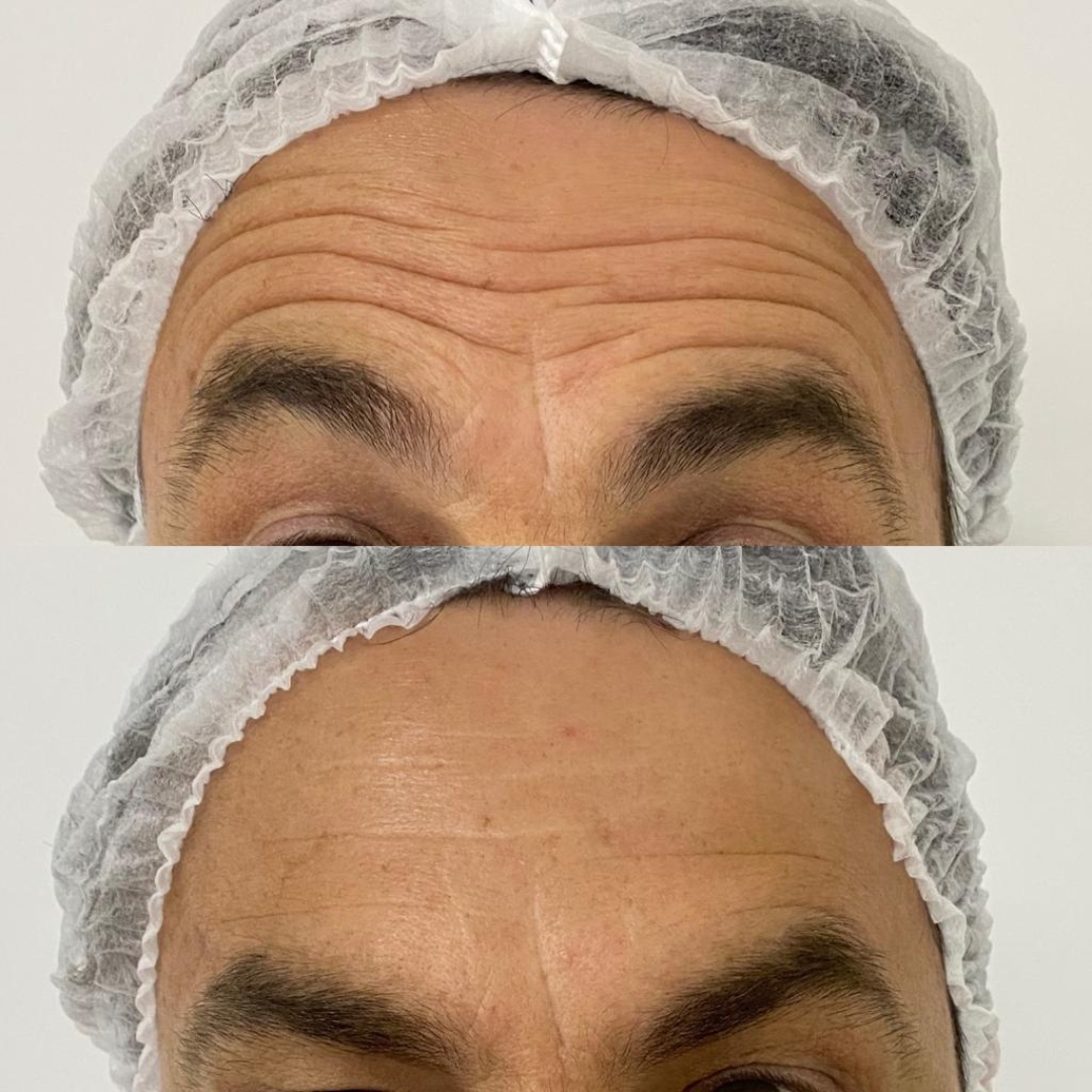 Toxina Botulínica (2)