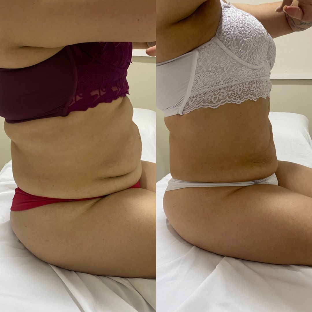 Tratamento para Gordura Localizada