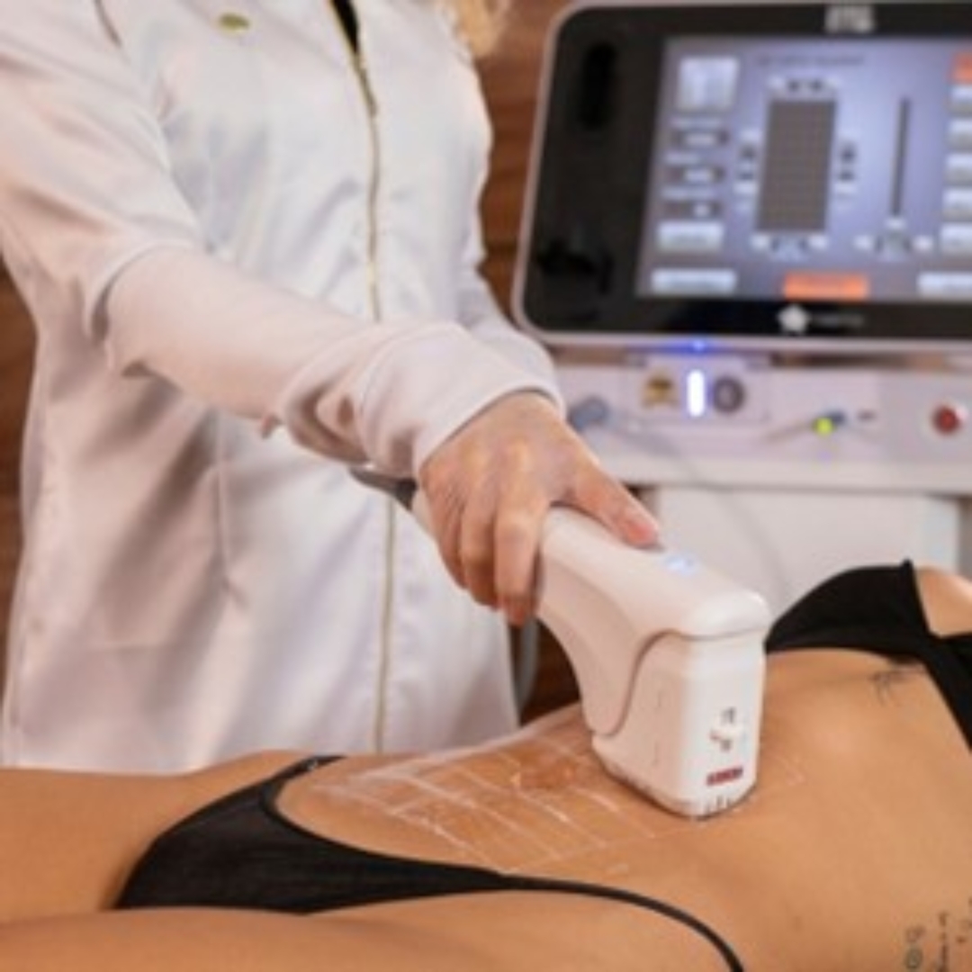 Ultrassom Macrofocado Herus Hifu